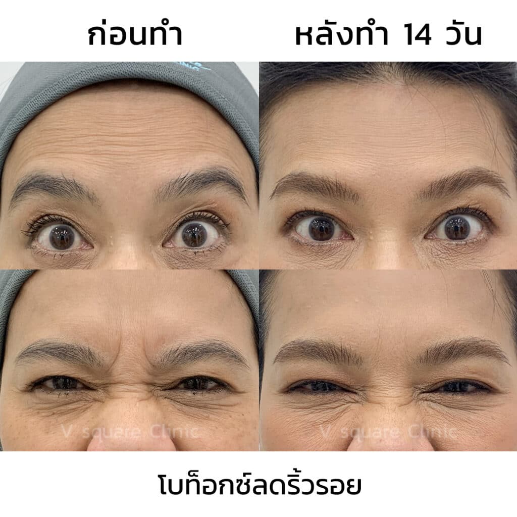 หลังฉีดโบท็อกริ้วรอย_คุณยุ้ย