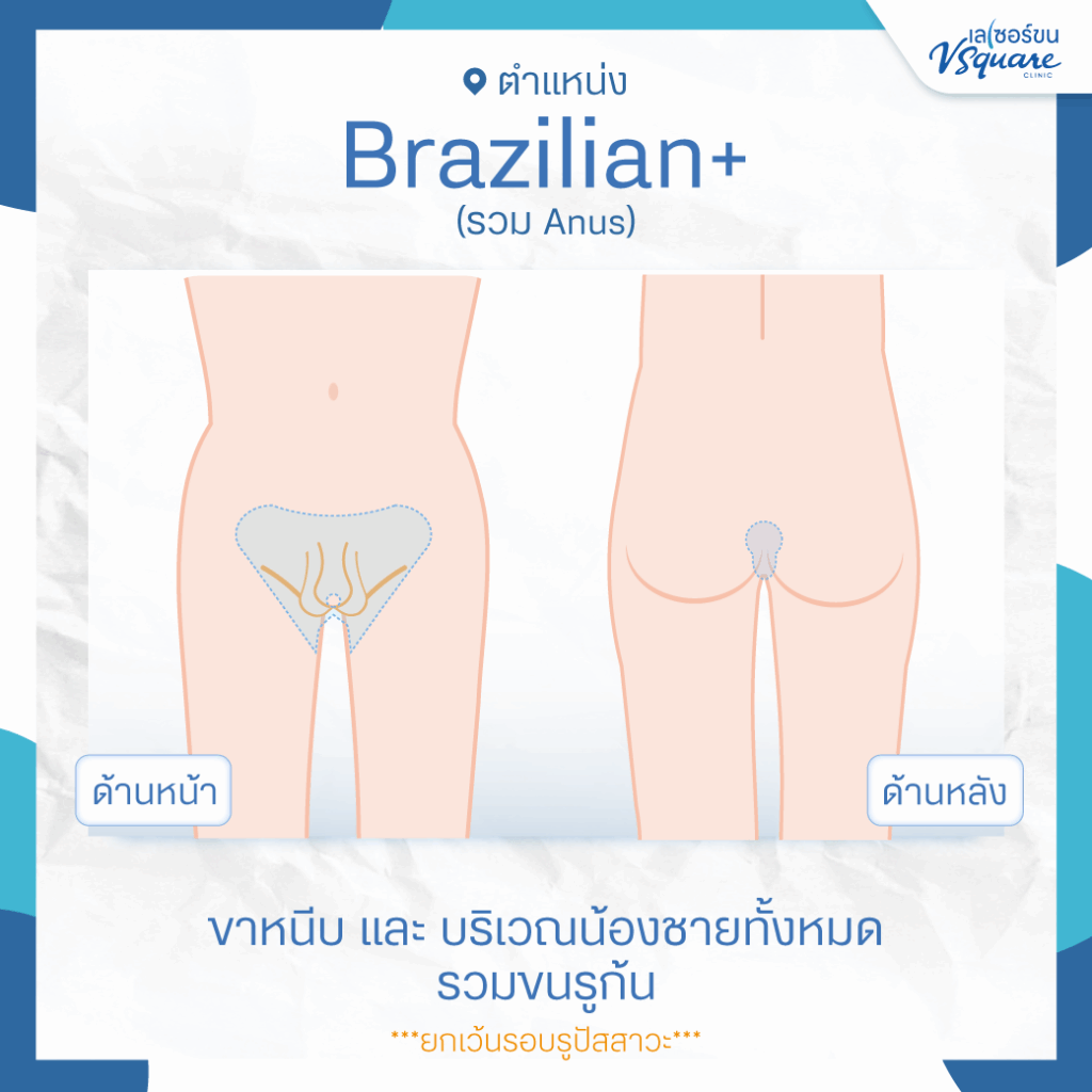 เลเซอร์กำจัดขนน้องชาย ทำได้บริเวณไหนบ้าง