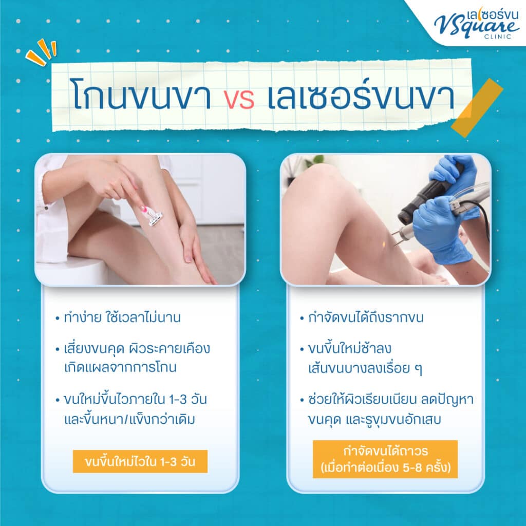 เลเซอร์ขนขา vs โกนขนขา