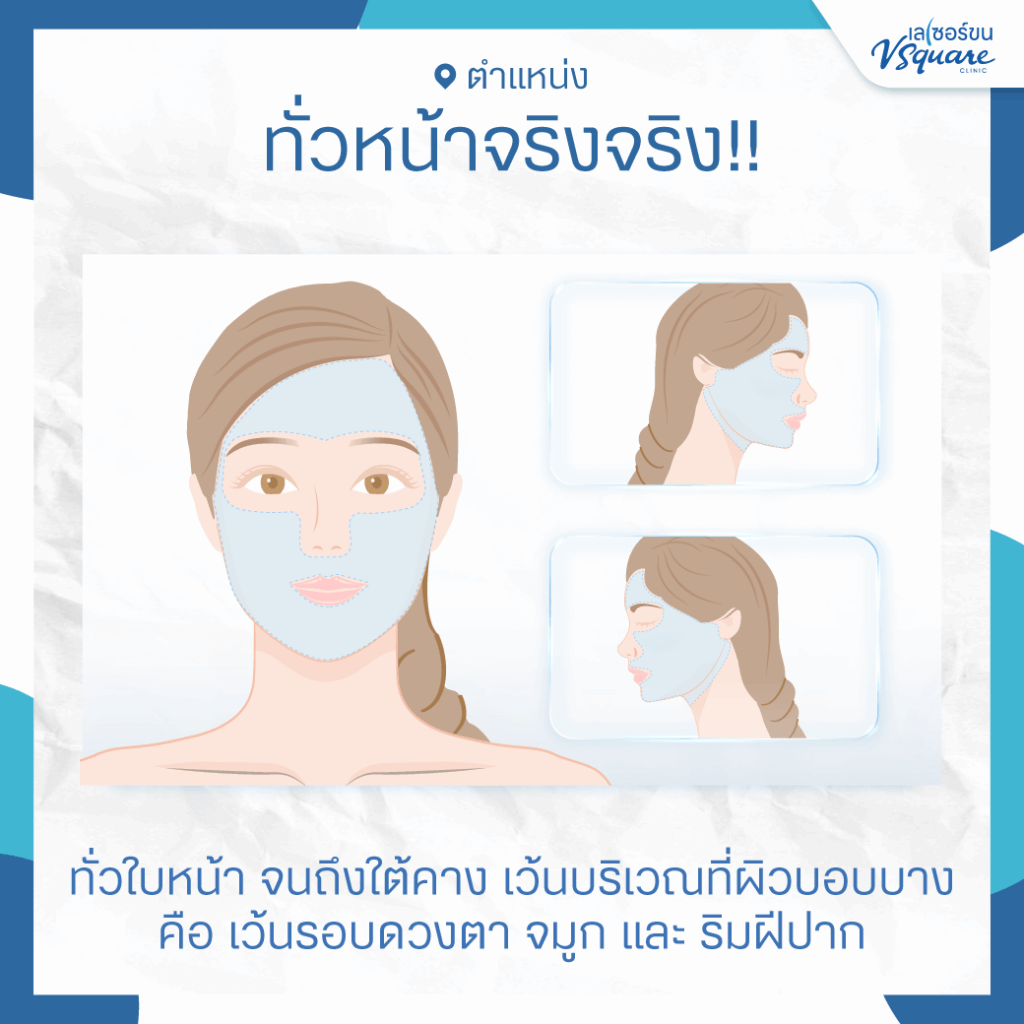 เลเซอร์ขนที่หน้า ทำทั่วหน้าไหม