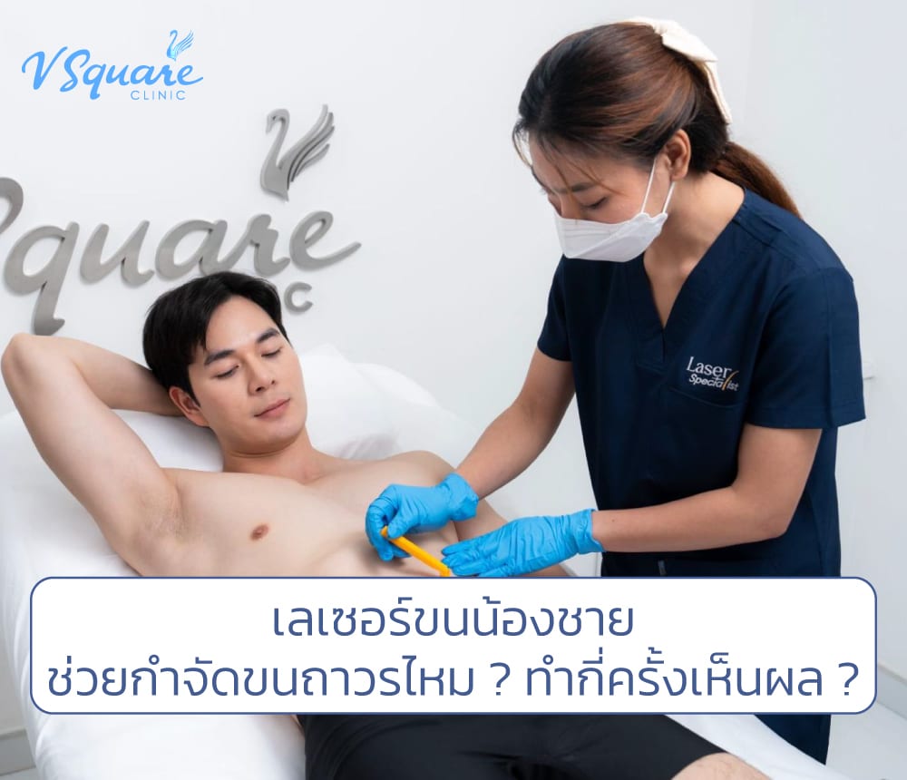 เลเซอร์ขนน้องชาย