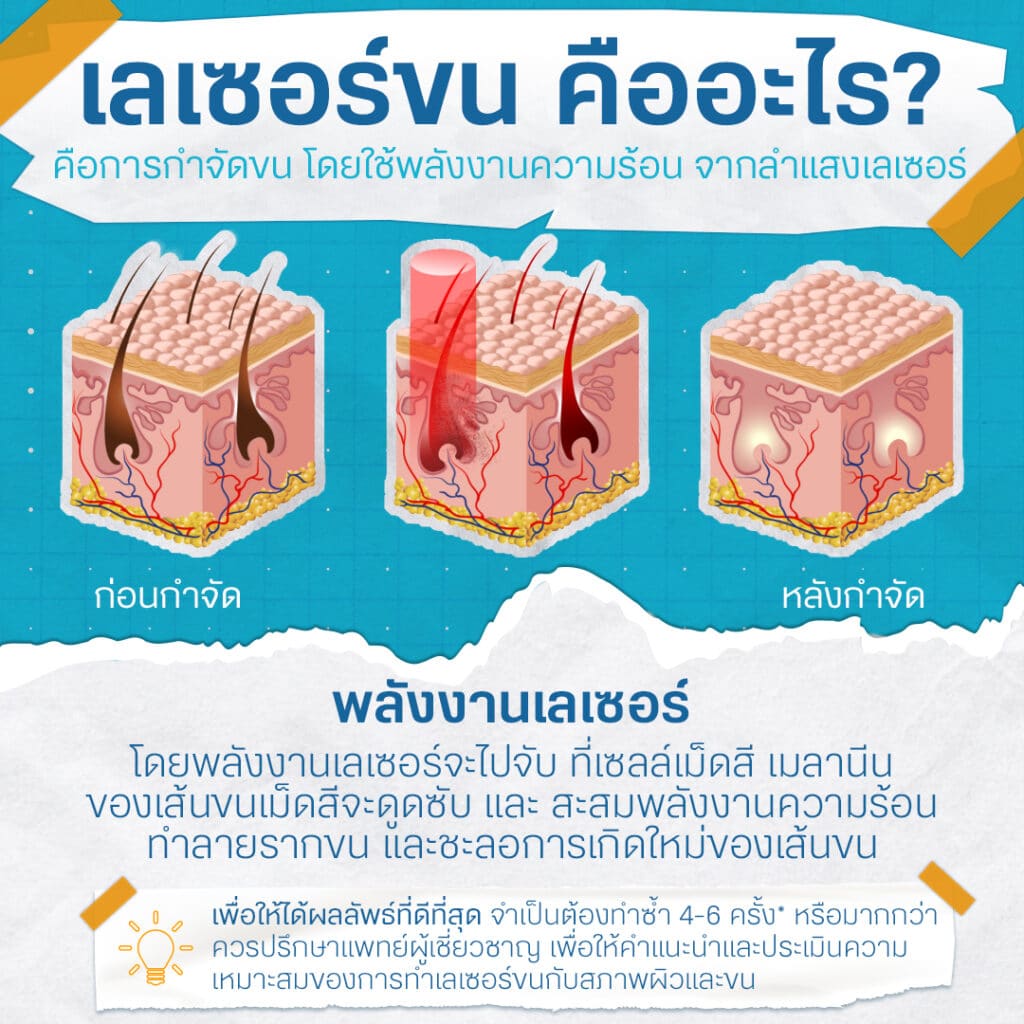 เลเซอร์ขนรักแร้ ถาวรไหม