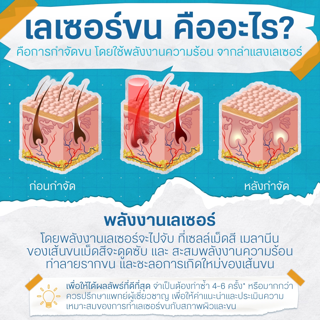 เลเซอร์ขนรักแร้ ถาวรไหม