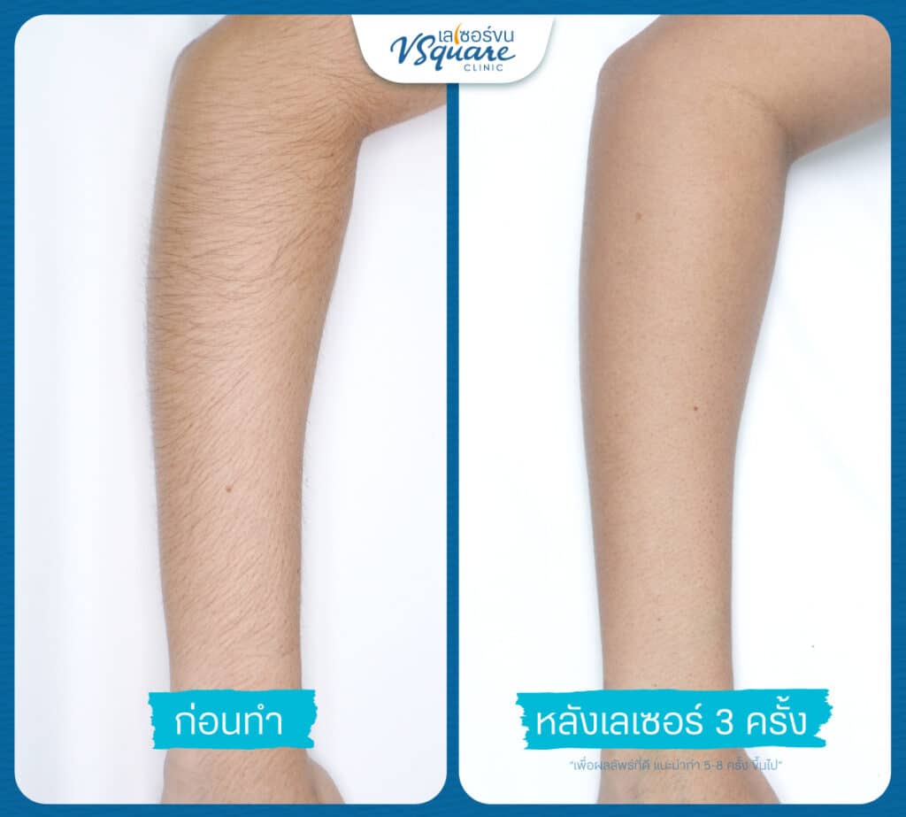 เลเซอร์ขนแขน รีวิว