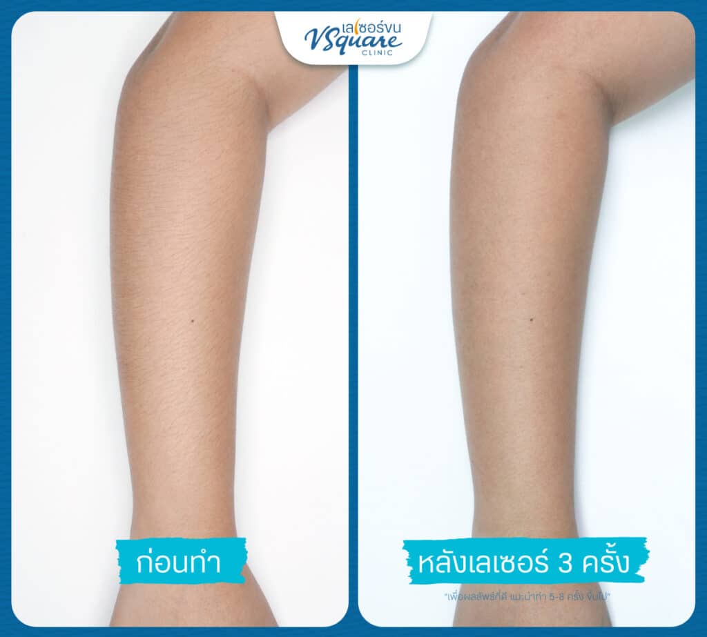 เลเซอร์ขนแขน รีวิว
