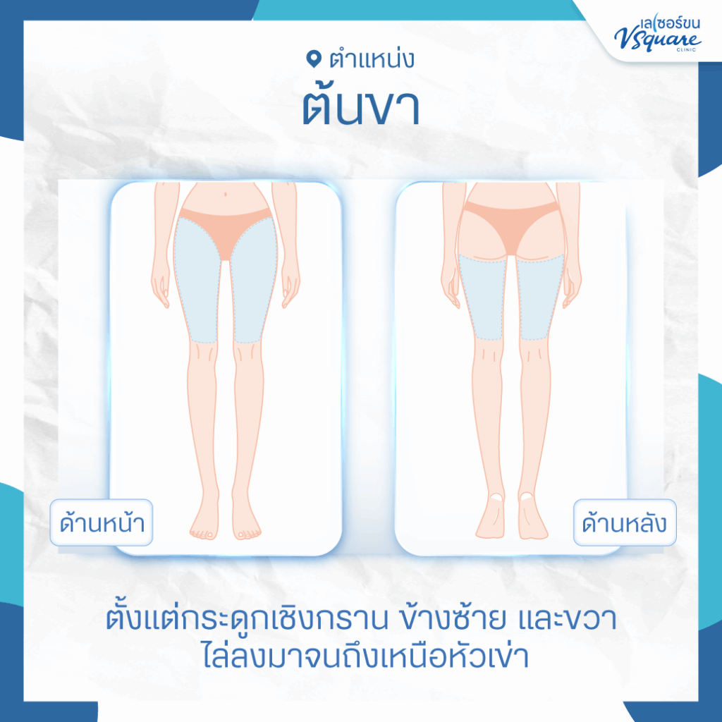 เลเซอร์ขาบน