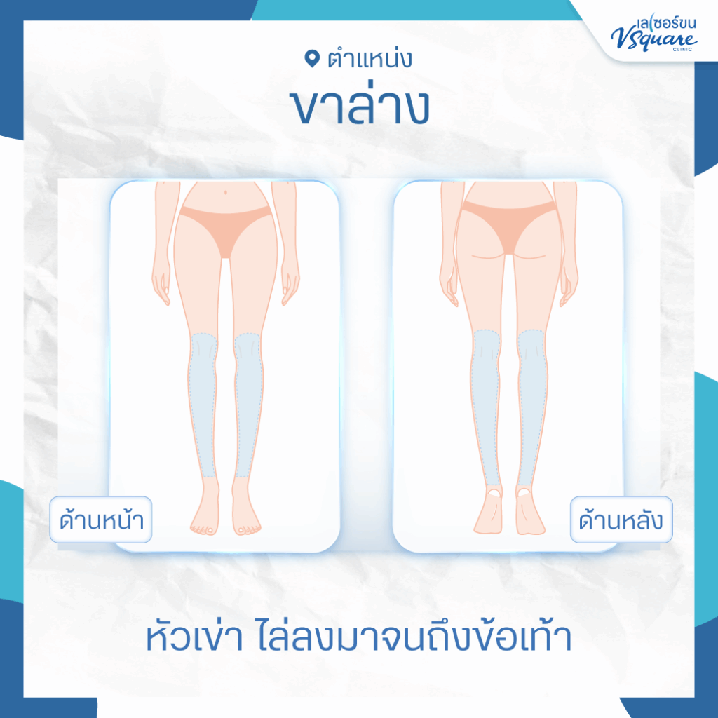 เลเซอร์ขาล่าง