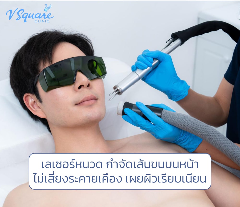 เลเซอร์หนวด
