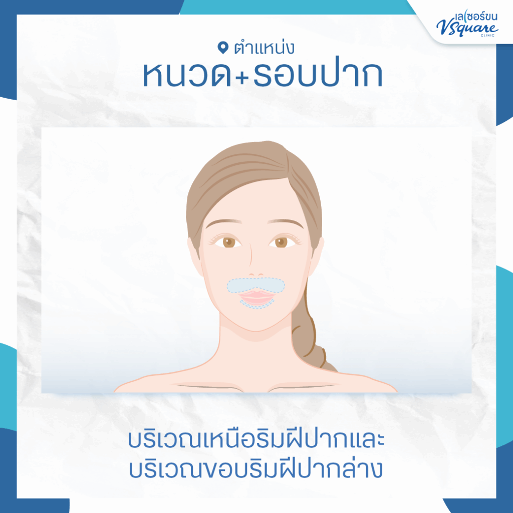 เลเซอร์หนวด