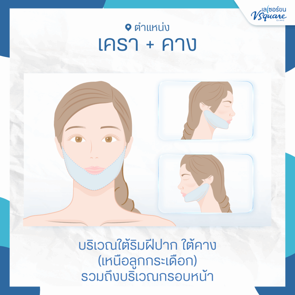 เลเซอร์เครา