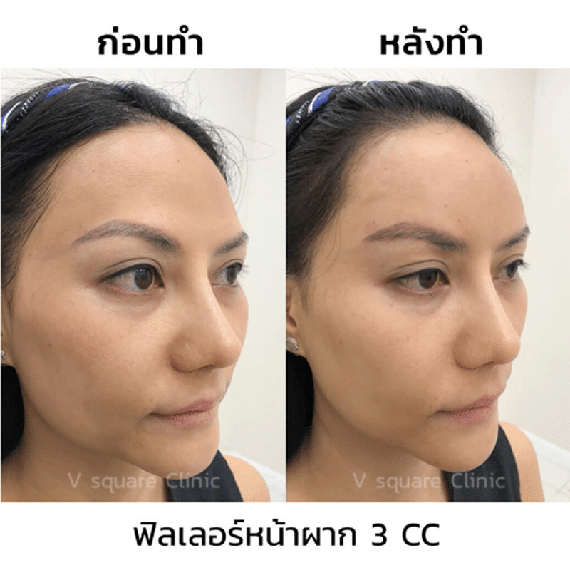 การฉีดสลายฟิลเลอร์(1)
