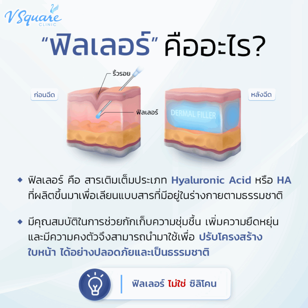 ฟิลเลอร์คืออะไร