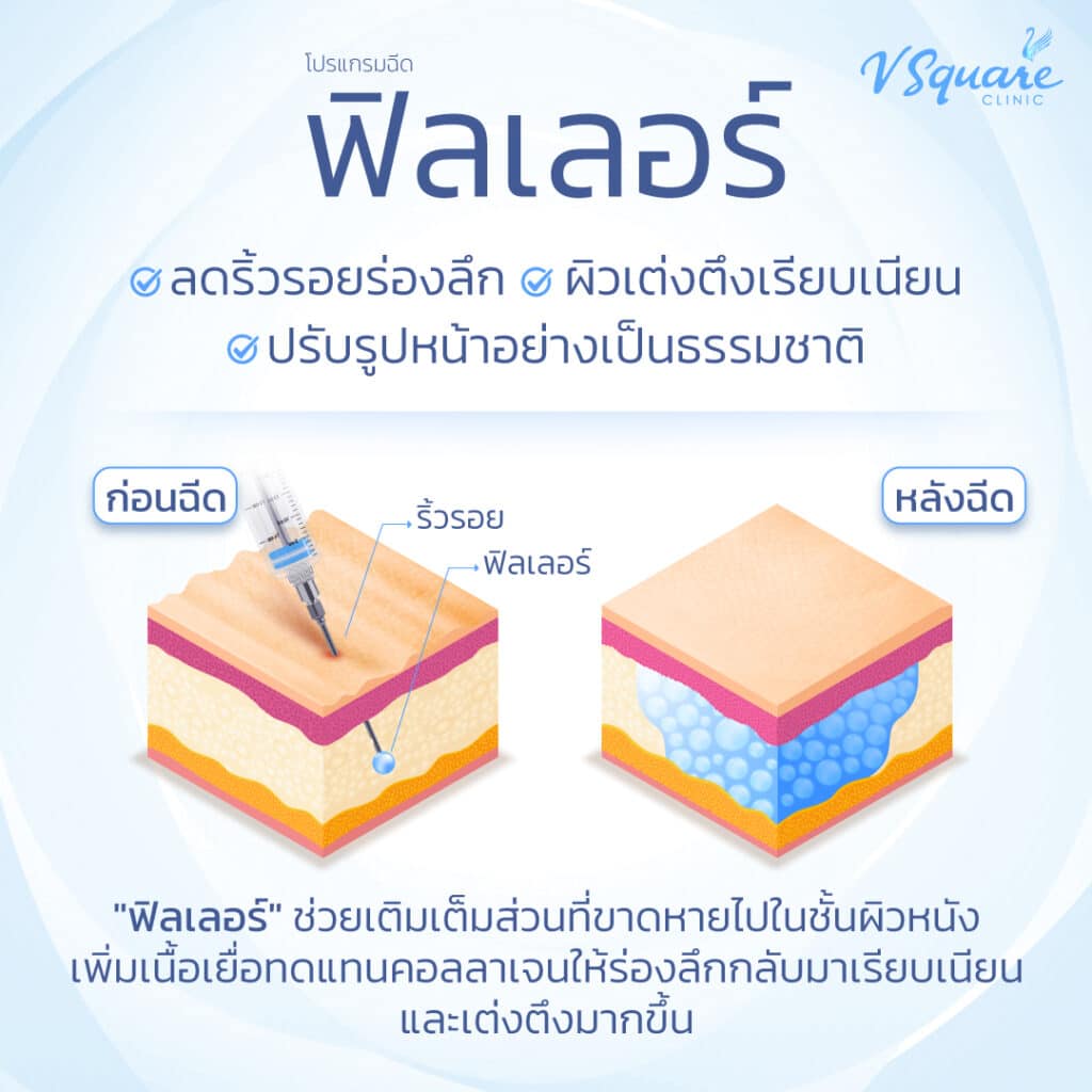 ฟิลเลอร์ช่วยอะไร