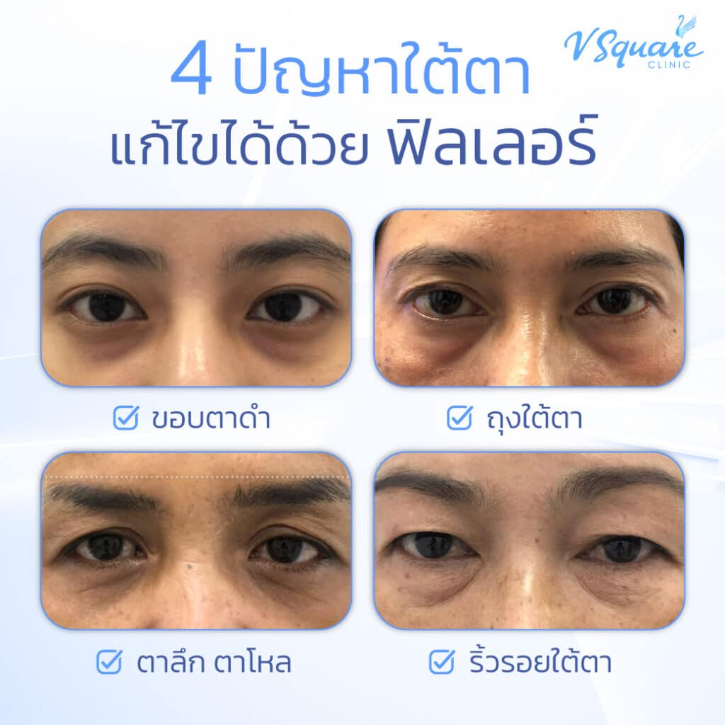 ฟิลเลอร์ใต้ตาเหมาะกับใคร