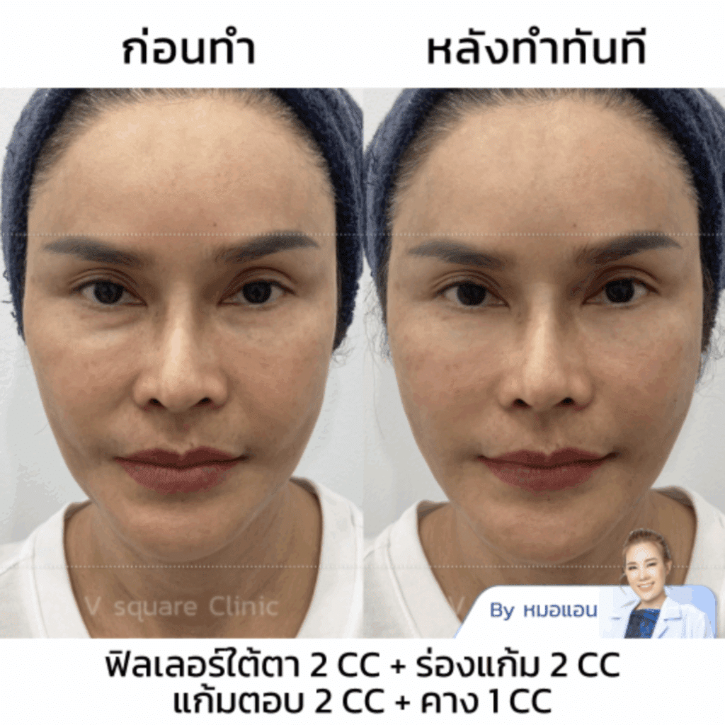 รีวิว ฉีด Filler คาง