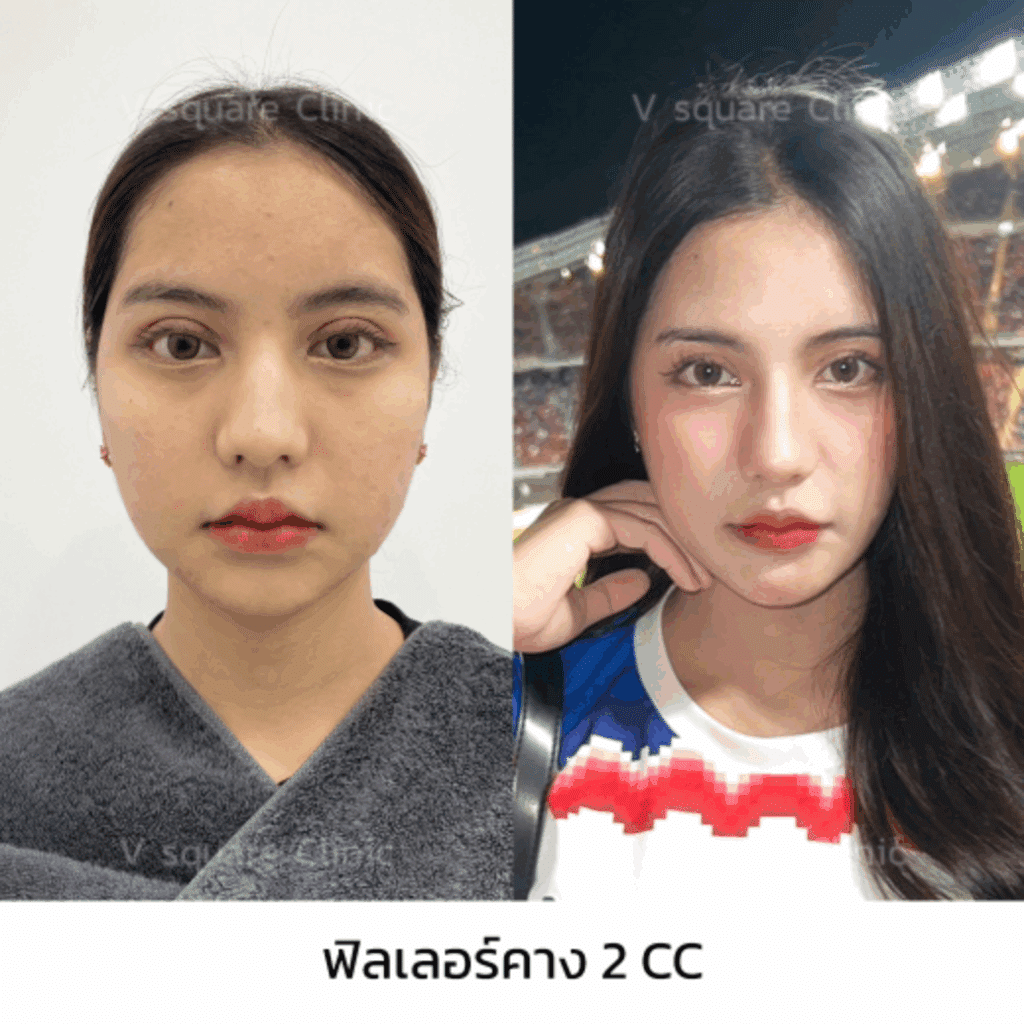 รีวิวฉีดฟิลเลอร์คาง_คุณปอปอ อินฟลู