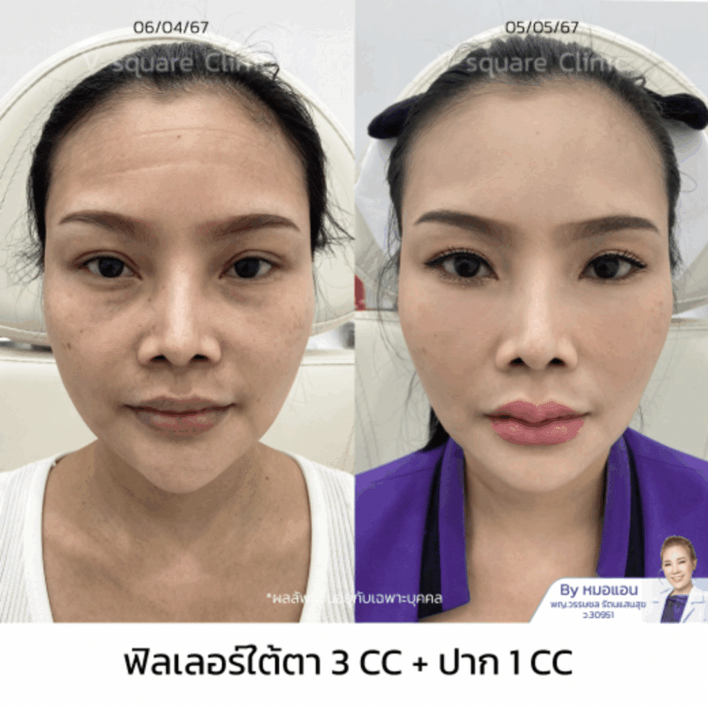 รีวิวฉีดฟิลเลอร์ปาก-ใต้ตา_คุณเขมิสรา