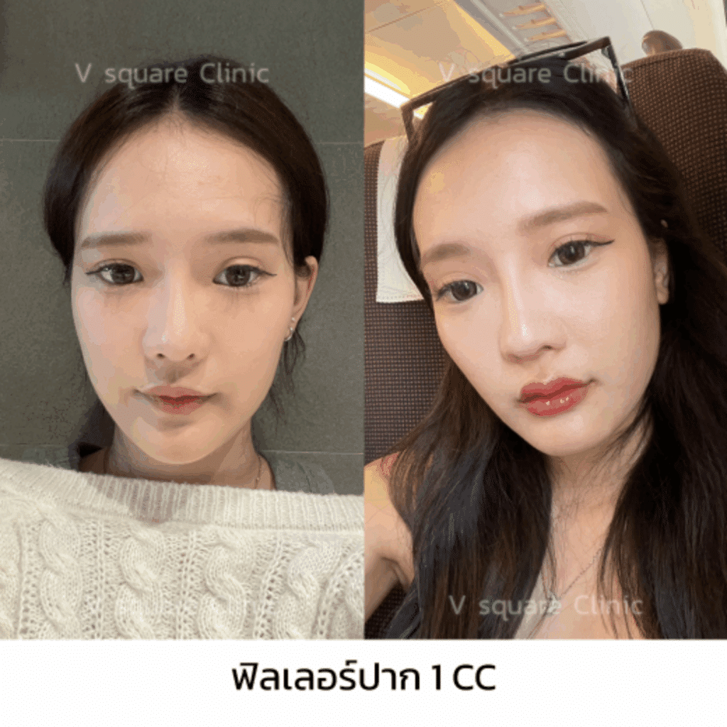 รีวิวฉีดฟิลเลอร์ปาก_คุณโมกุล อินฟลู