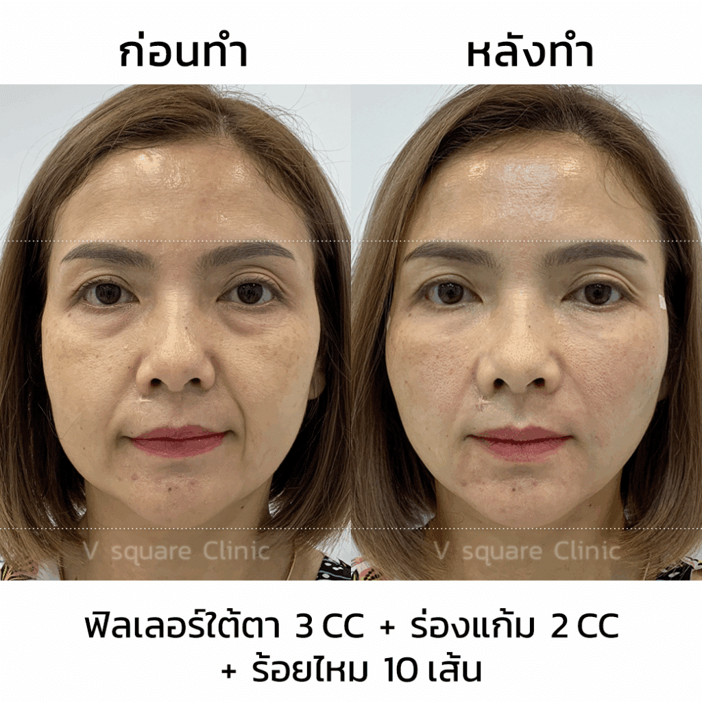 รีวิวฉีดฟิลเลอร์ใต้ตา