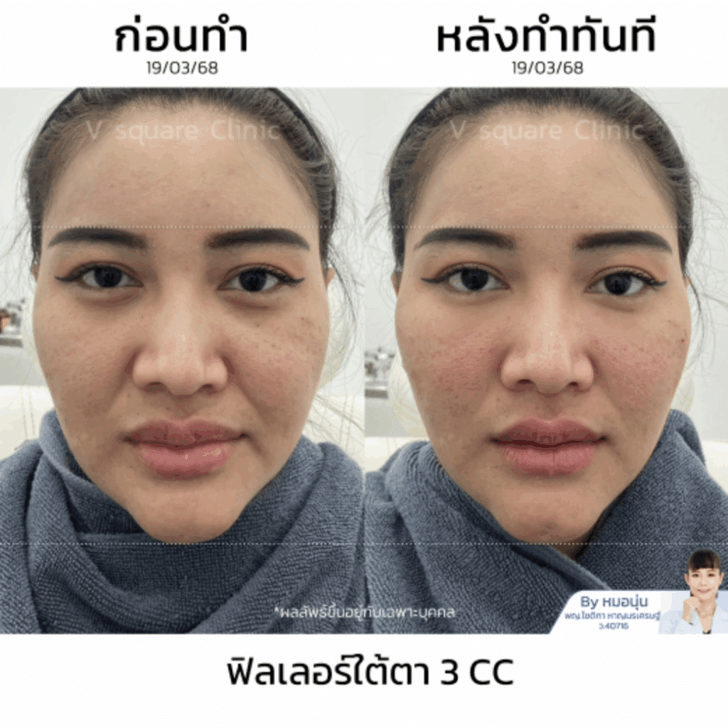 รีวิวฉีดฟิลเลอร์ใต้ตา_ณัฐธิดา