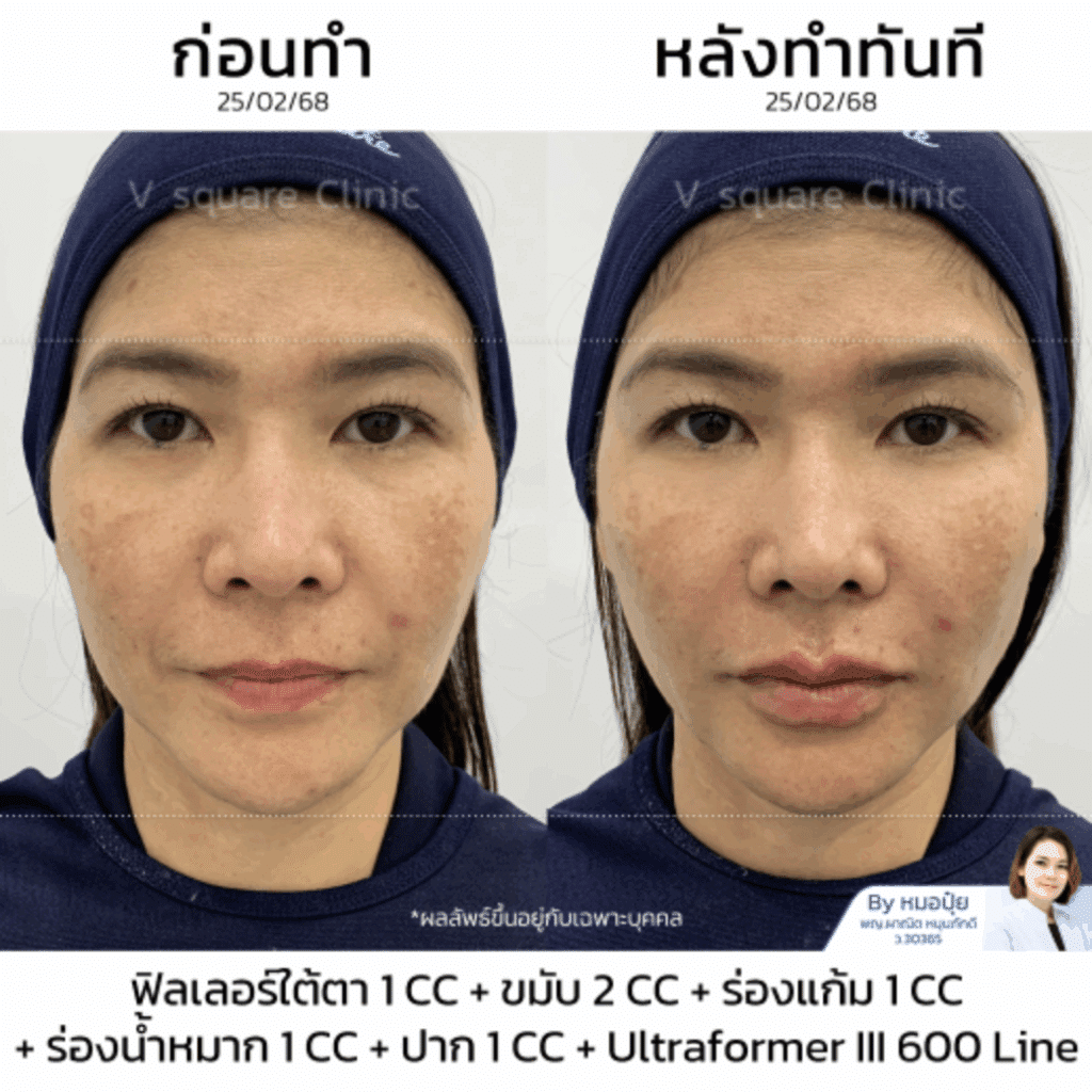 รีวิวฟิลเลอร์ร่องน้ำหมาก_คุณหมวย