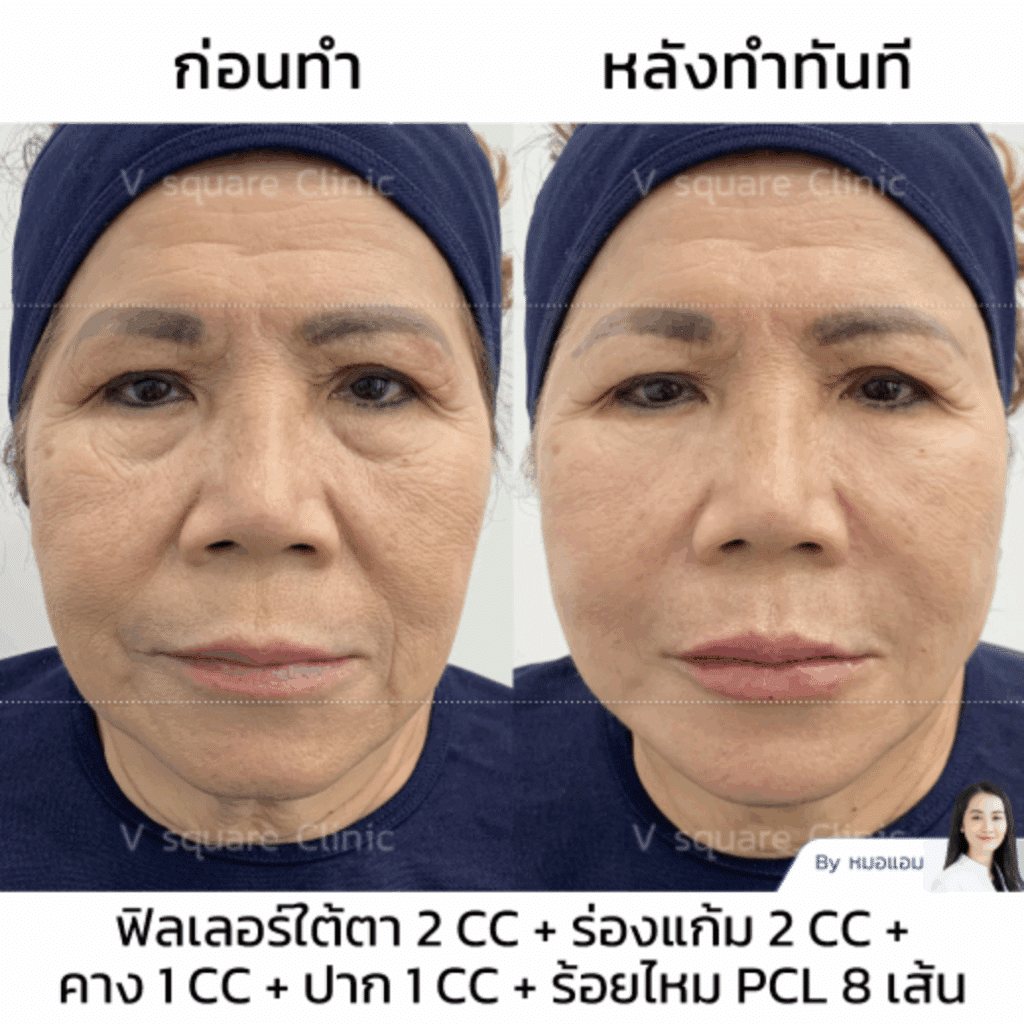 รีวิวฟิลเลอร์ร่องแก้ม_คุณหมวย