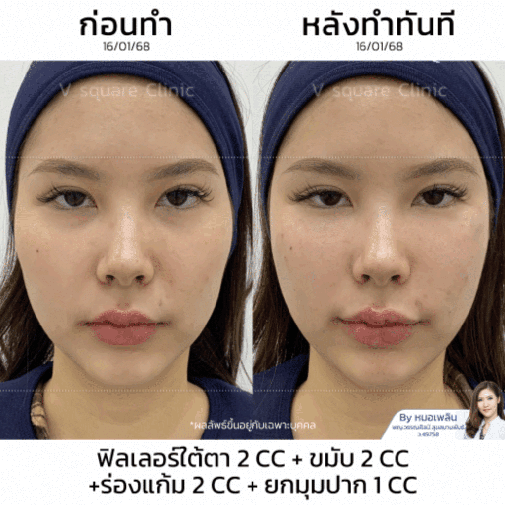 รีวิวฟิลเลอร์ร่องแก้ม_คุณเฟิร์น Influencer