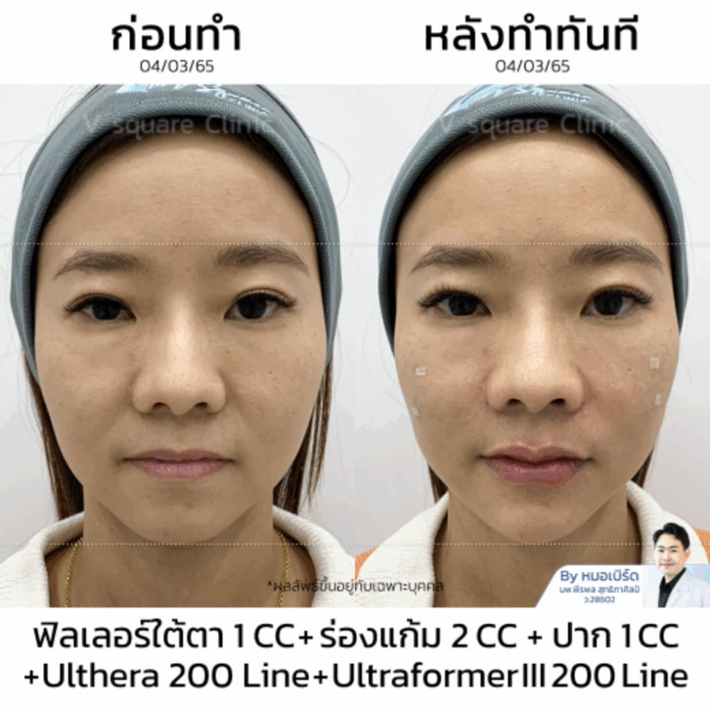 รีวิวฟิลเลอร์ร่องแก้ม_ใต้ตา_คุณแสง