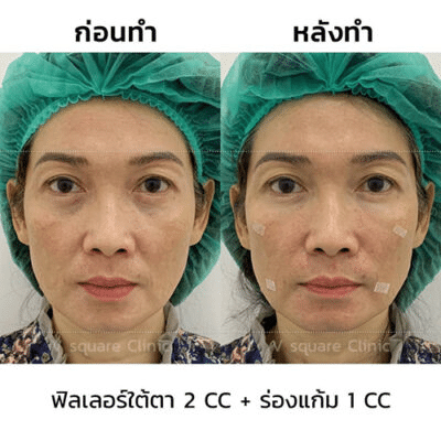 รีวิวฟิลเลอร์ใต้ตา