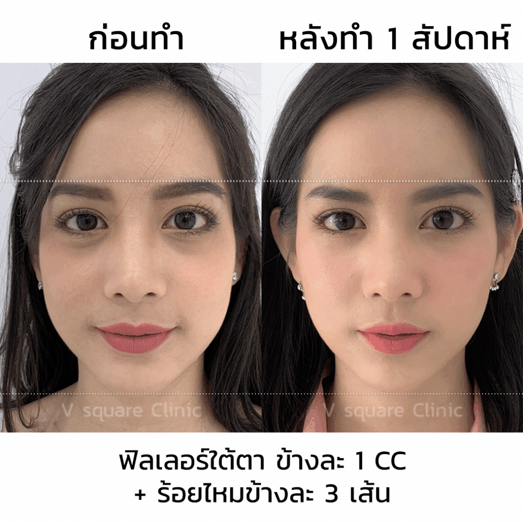 รีวิวฟิลเลอร์ใต้ตา