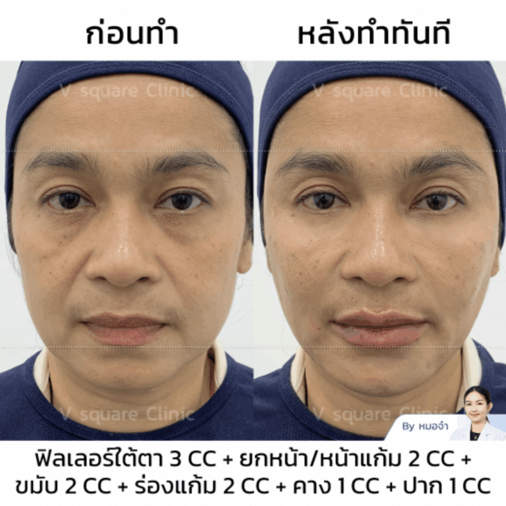 รีวิวฟิลเลอร์ใต้ตา_คุณกบ_แบบเบสๆ