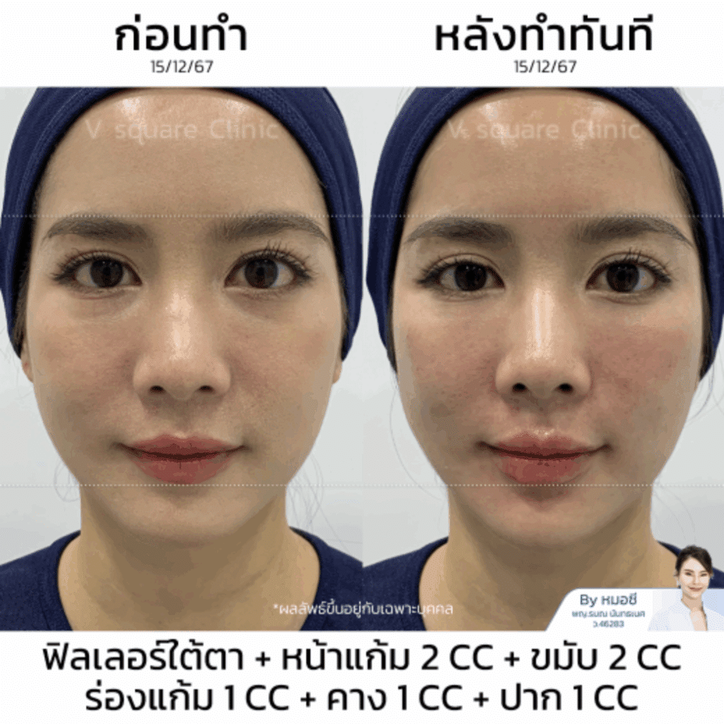 รีวิวฟิลเลอร์ใต้ตา_คุณกุ๊กกิ๊ก