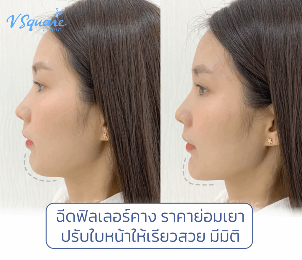 ฉีดฟิลเลอร์คาง ราคา