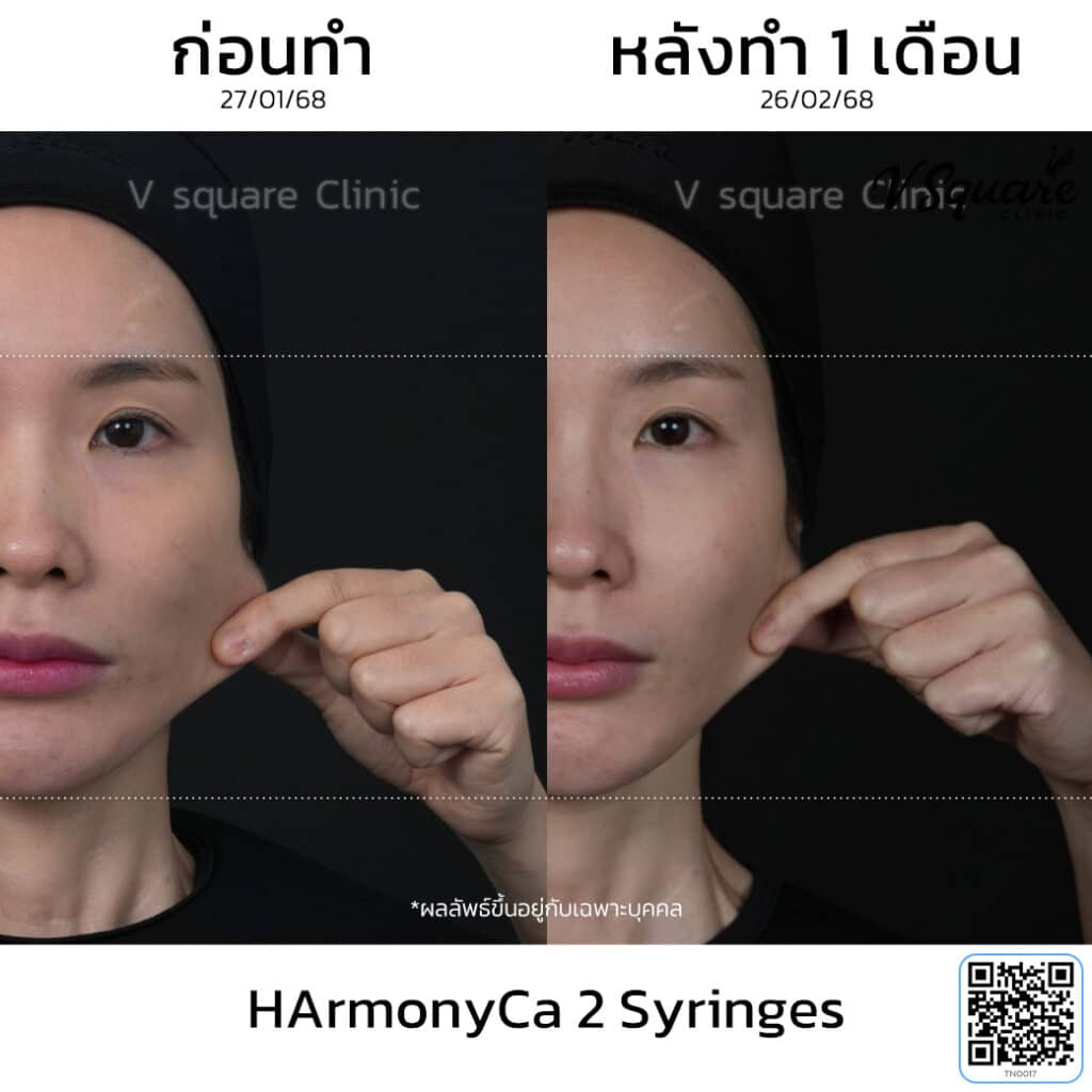รีวิว HArmonyCa 1 เดือน_พี่พิน