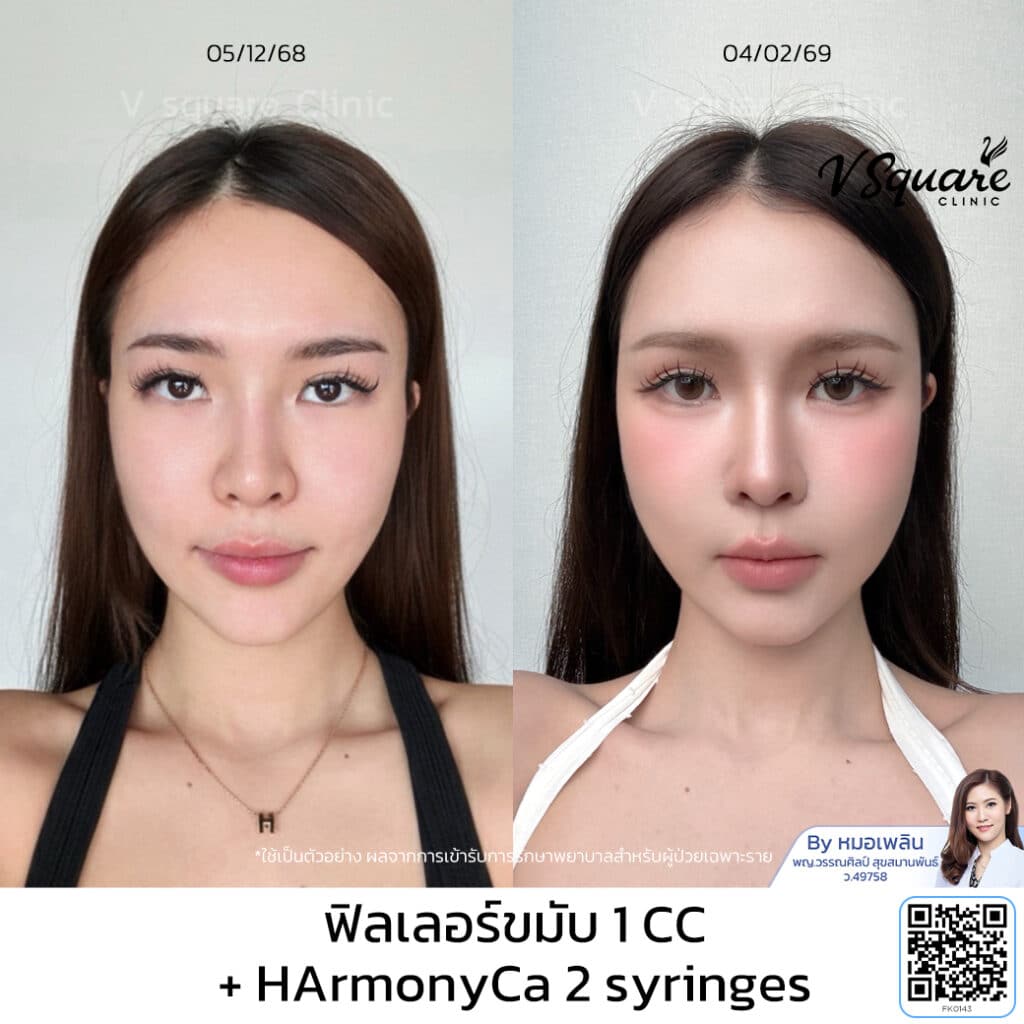 รีวิว HArmonyCa_คุณแบม_หมอเพลิน