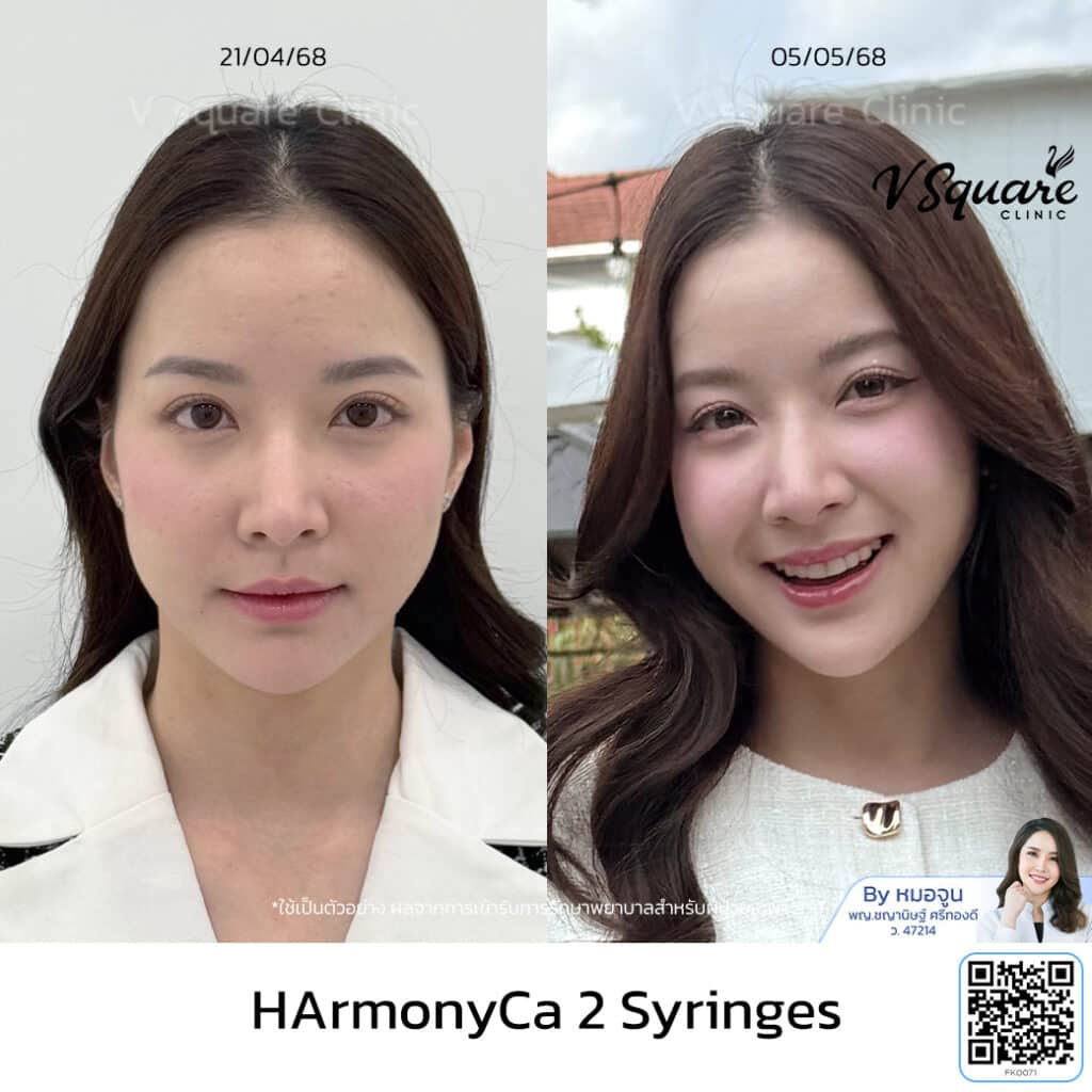 รีวิว HArmonyCa_มุก_หมอจูน