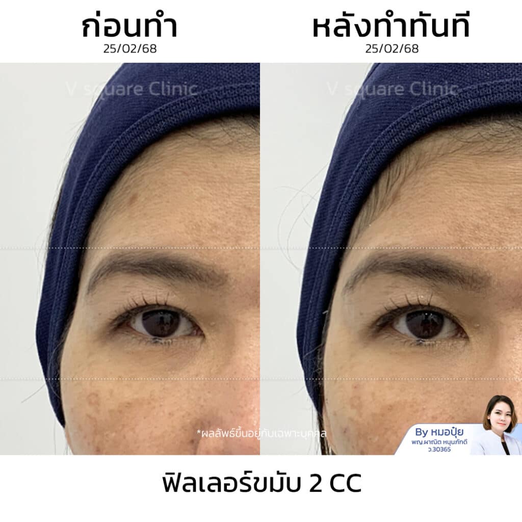 รีวิวฉีดฟิลเลอร์ขมับ_คุณหมวย