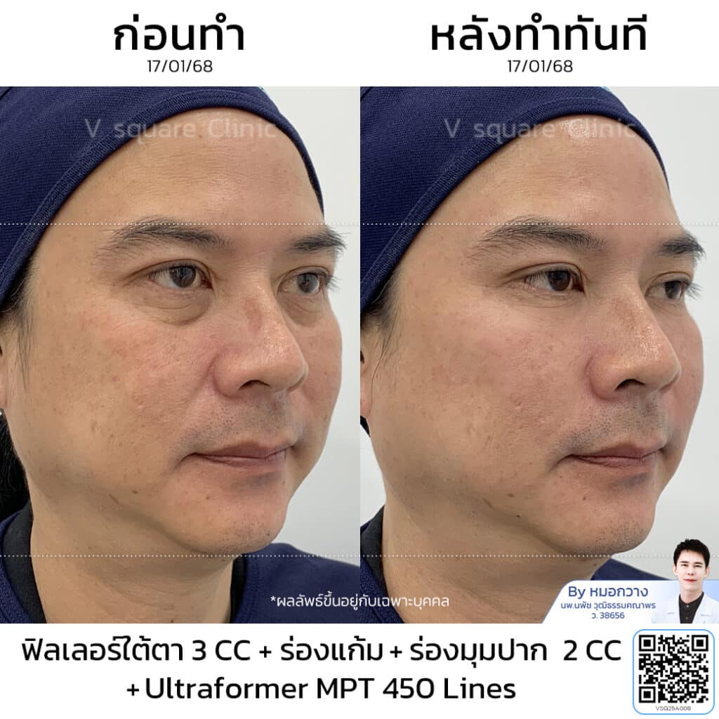 รีวิวฉีดฟิลเลอร์ร่องแก้ม_คุณจั๊ก โดย หมอ กวาง