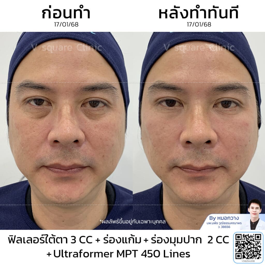 รีวิวฉีดฟิลเลอร์ร่องแก้ม_คุณจั๊ก โดย หมอ กวาง