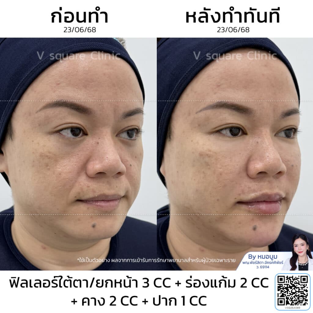 รีวิวฉีดฟิลเลอร์ร่องแก้ม_คุณปาย (แบบเบสๆ) โดย หมอ บูม
