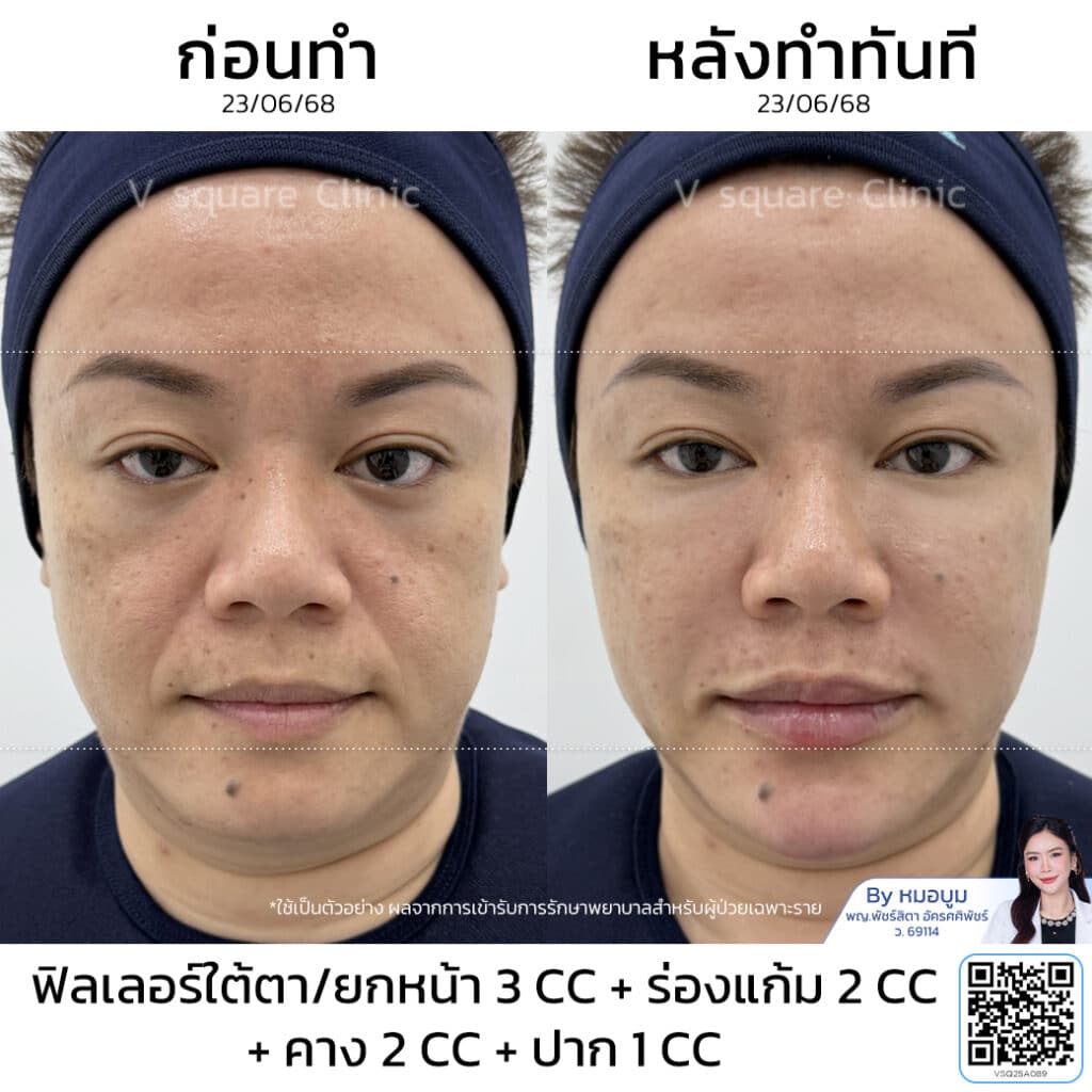 รีวิวฉีดฟิลเลอร์ร่องแก้ม_คุณปาย (แบบเบสๆ) โดย หมอบูม