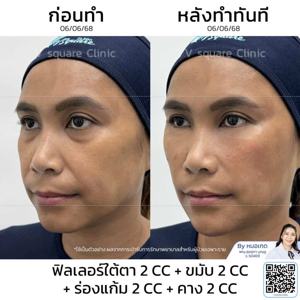 รีวิวฉีดฟิลเลอร์ร่องแก้ม_คุณอ้ (แบบเบสๆ) โดย หมอเกด