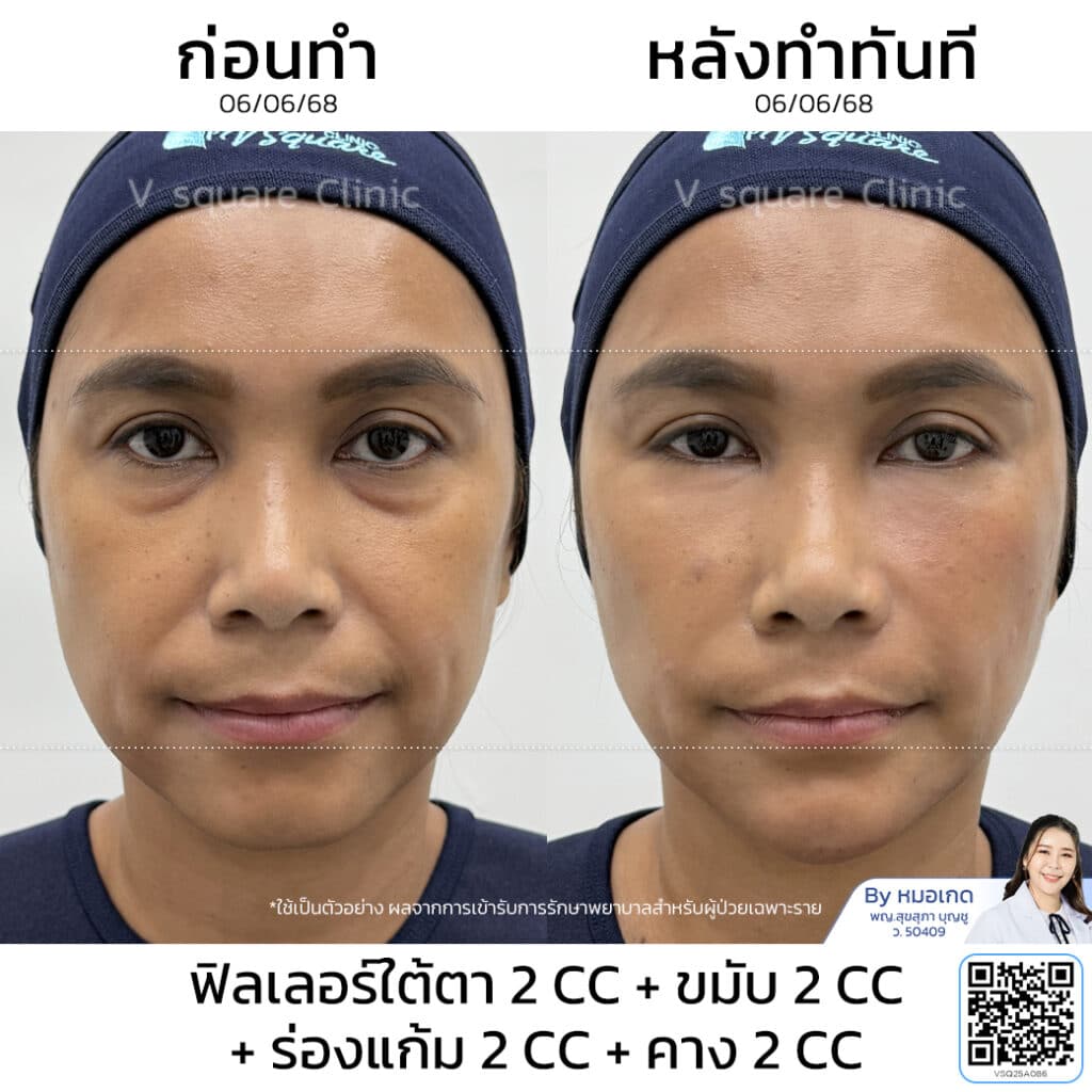 รีวิวฉีดฟิลเลอร์ร่องแก้ม_คุณอ้ (แบบเบสๆ) โดย หมอ เกด