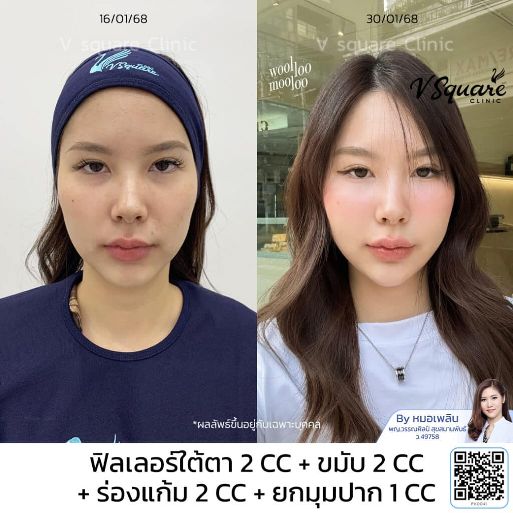 รีวิวฉีดฟิลเลอร์ร่องแก้ม_เฟิร์น โดย หมอ เพลิน