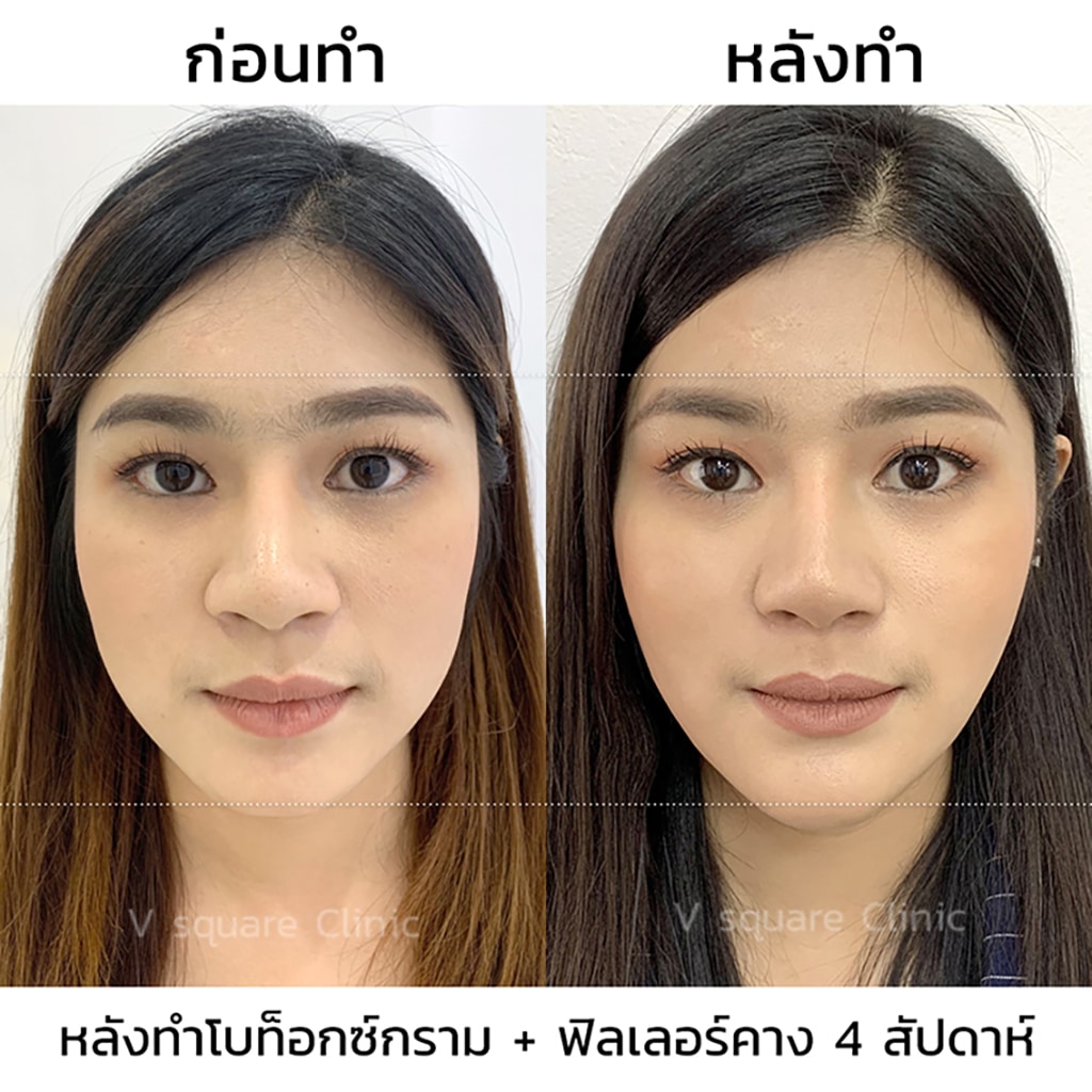 รีวิวผลลัพธ์หลังฉีดฟิลเลอร์คาง 4 สัปดาห์