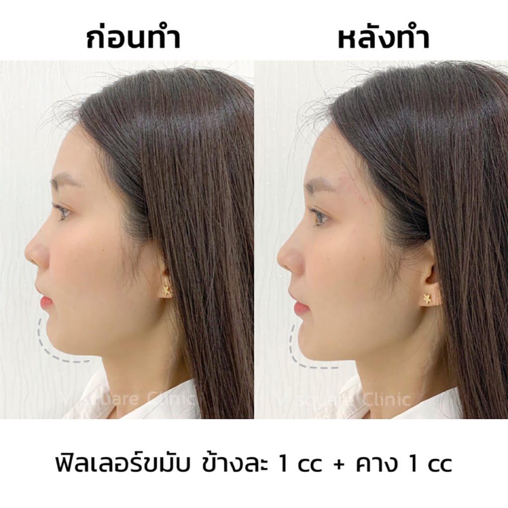 ข้อปฎิบัติหลังฉีดฟิลเ