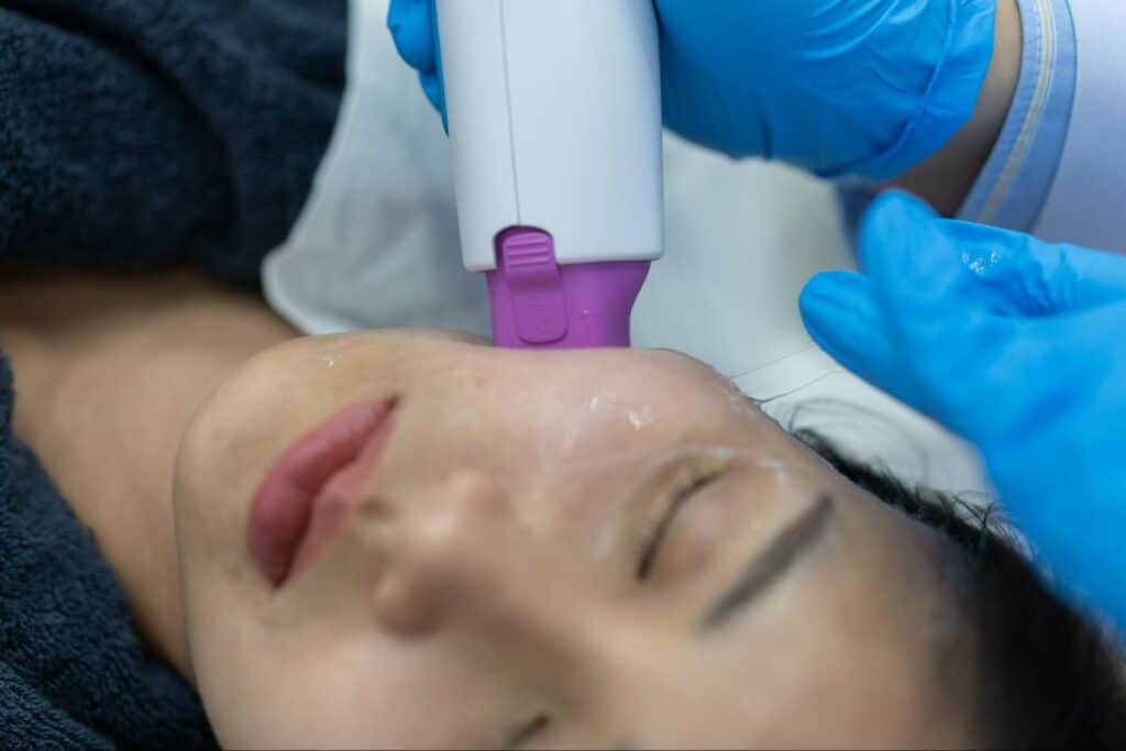 Thermage ลดริ้วรอยร่องแก้ม