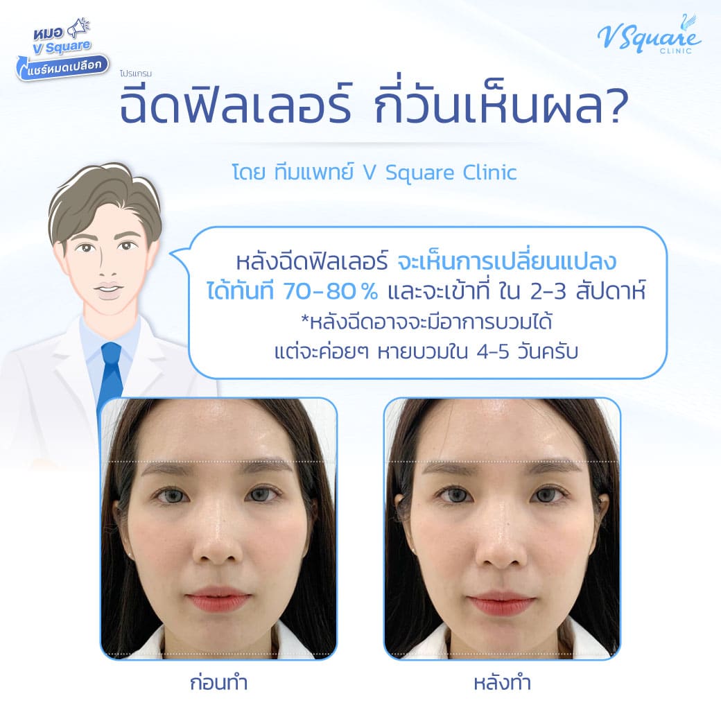 หลังฉีดฟิลเลอร์ กี่วันเห็นผล