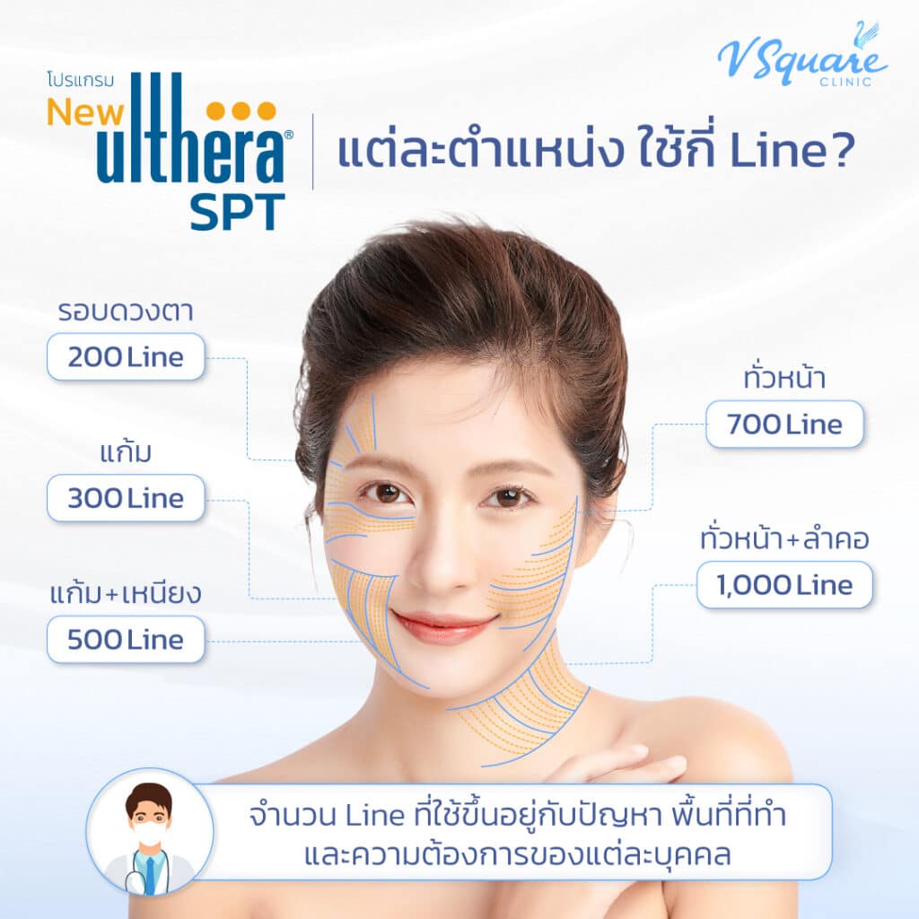 จำนวนไลน์ทำUlthera แต่ละตำแหน่ง