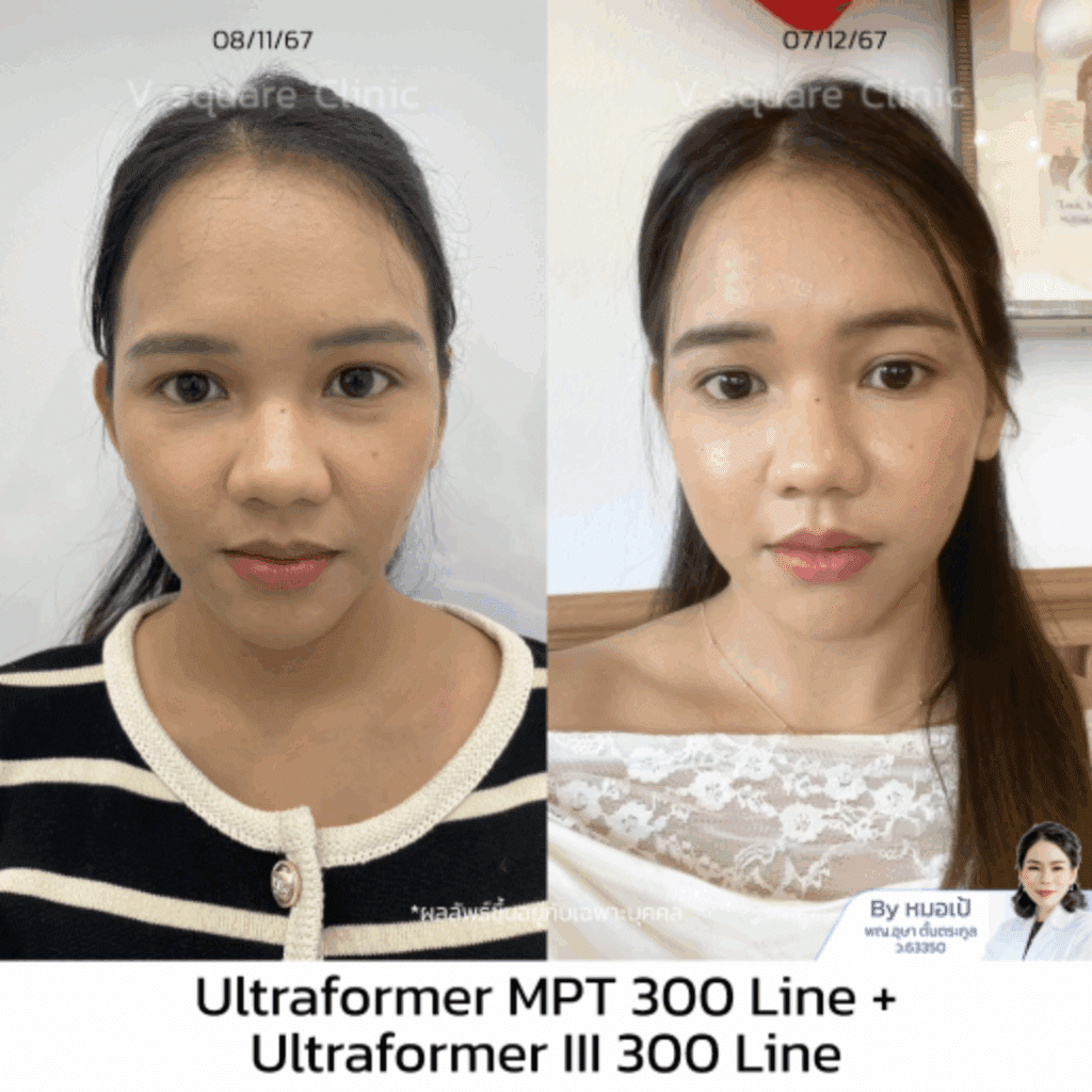 รีวิว hifu ลดร่องแก้ม_มายด์ (นักกายทำ)